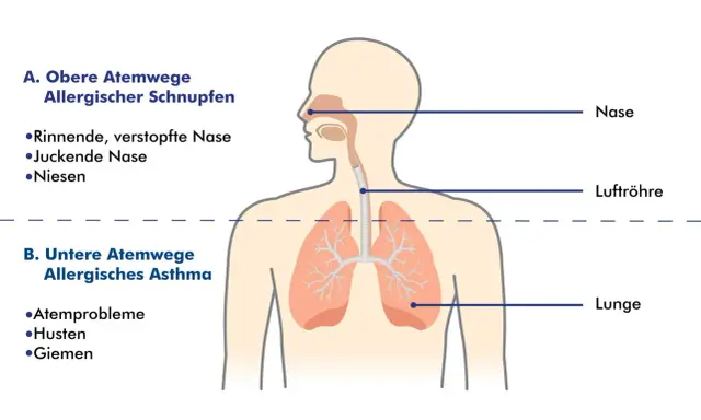 Schema zeigt obere Atemwege (allergischer Schnupfen) und untere Atemwege (allergisches Asthma). So kann man allergisches Asthma behandeln.