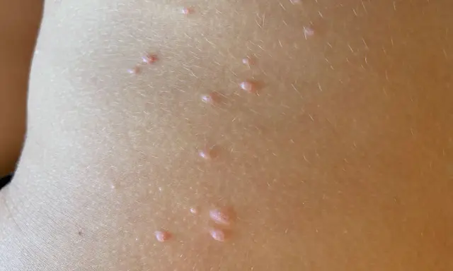 Piccolo dettaglio della pelle di un bambino con molluschi contagiosi, piccole protuberanze rosee che sembrano minuscoli molluschi.