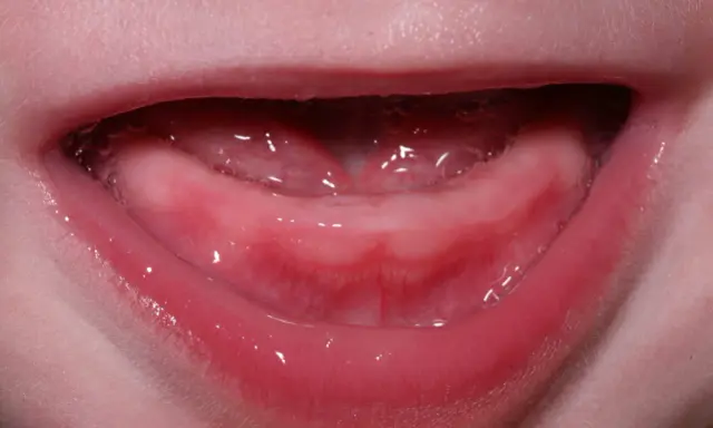 Gengive rosse e gonfie di un neonato, con piccole bollicine di saliva. Inizia la dentizione, un momento emozionante per la dentizione del neonato.