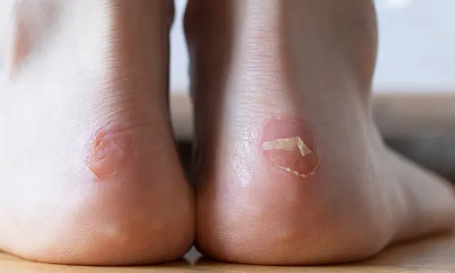 Gros plan sur des talons avec des ampoules, dont une avec un pansement. L'éosine sur ampoule révèle la peau irritée.