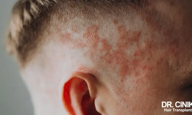 Psoriasis du cuir chevelu, souvent exacerbée par le stress, se manifeste par des plaques rouges et squameuses près de l'oreille.