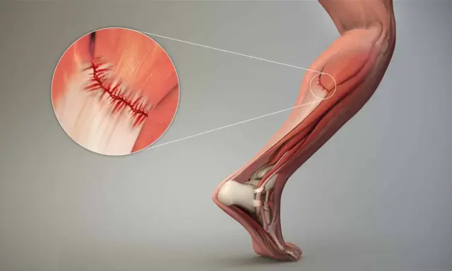 Dettaglio di lesioni muscolari con suture, illustrando il trattamento chirurgico per la riparazione.