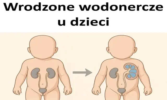 Ilustracja pokazuje powiększoną nerkę u dziecka, co może być objawem wrodzonych wad układu moczowego.