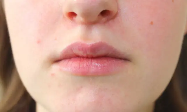 Primo piano del viso con labbra e naso. Si nota una leggera dermatite intorno al naso, con arrossamenti e piccole imperfezioni.