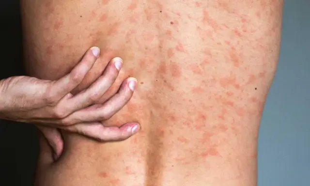 Une main gratte le dos couvert de plaques rouges, signe d'urticaire due au stress.