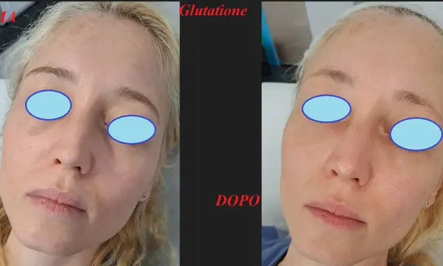 Prima e dopo un trattamento di glutatione per un miglioramento visibile del risultato peeling chimico.