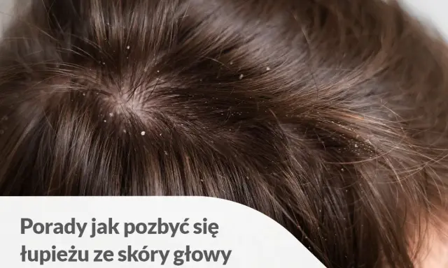 Widoczne białe płatki na ciemnych włosach i skórze głowy. Porady jak pozbyć się łupieżu ze skóry głowy.