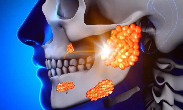 Illustrazione anatomica delle ghiandole salivari, con un focus sui possibili sintomi di un tumore ghiandole salivari: gonfiore e masse visibili.