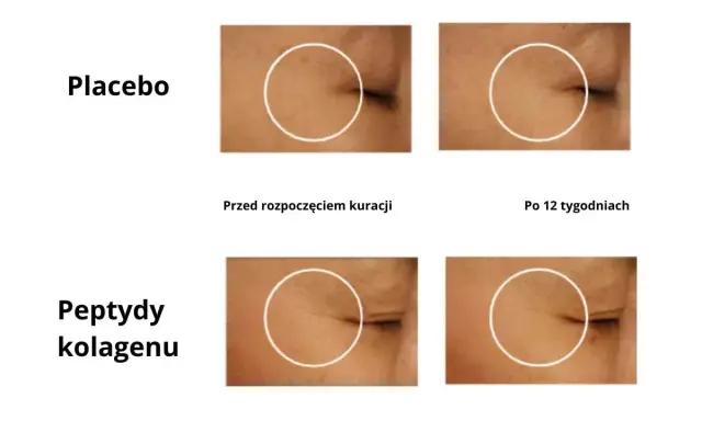 Porównanie skóry przed i po 12 tygodniach: placebo vs. peptydy kolagenu.