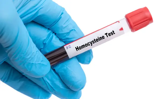 Rękawiczka w kolorze niebieskim trzyma probówkę z krwią do badania homocysteiny. Co to za badanie?