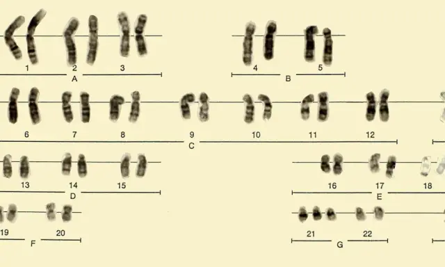 Cariotipo masculino con cromosomas ordenados por tamaño y forma, incluyendo los cromosomas sexuales X e Y.