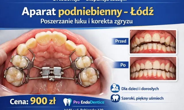Aparat podniebienny, czyli aparat Hassa, poszerza łuk zębowy. Zdjęcia pokazują efekt przed i po leczeniu.