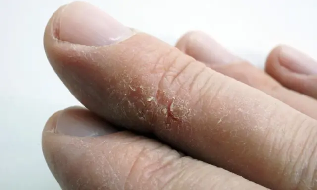 Gros plan sur des doigts montrant une peau sèche et craquelée, avec une crevasse visible sur un doigt.