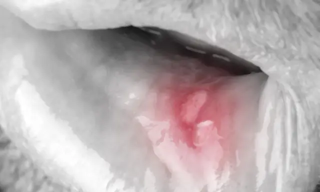 Afta i dentysta: Kiedy wizyta jest konieczna, a kiedy poczekać?