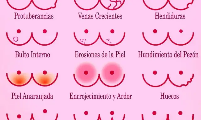 Síntomas cáncer de mama: ¿Qué señales no debes ignorar?
