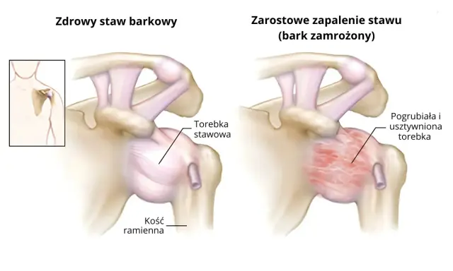 Porównanie zdrowego stawu barkowego z objawami zamrożonego barku: pogrubiała i usztywniona torebka stawowa.