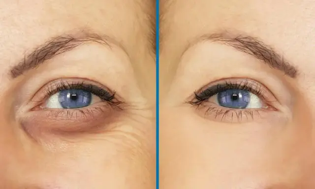 Antes y después de un tratamiento para cómo quitar las ojeras. Se observa una mejora notable en la zona debajo del ojo.