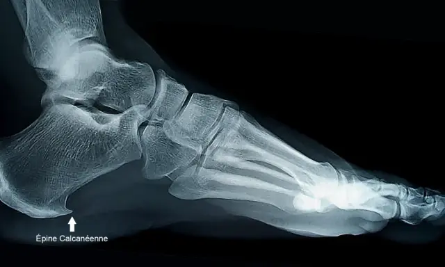 Radiographie latérale du pied montrant une épine calcanéenne, indiquant la nécessité d'une prise en charge adaptée.