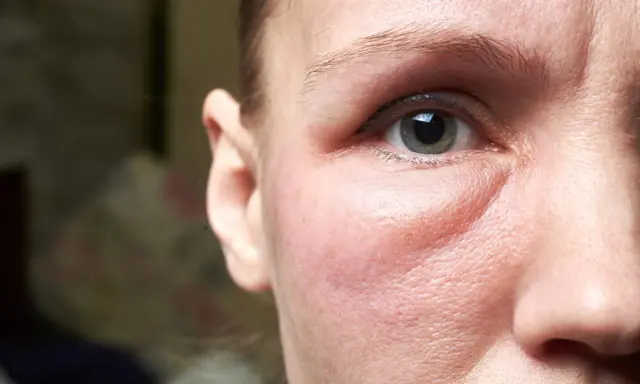 Un visage gonflé, peut-être un œdème, cherche un remède de grand-mère. Gros plan sur l'œil et la joue rougie.