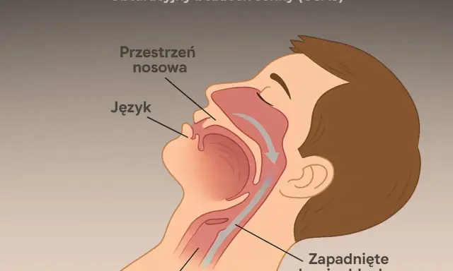 Ilustracja pokazuje przekrój głowy, wyjaśniając, **torsemed na co** wpływa obturacyjny bezdech senny (OSAS) – zapadnięte drogi oddechowe, język i przestrzeń nosową.