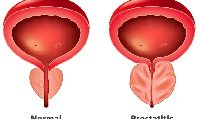 Porównanie prawidłowej i powiększonej prostaty. Zmiany w prostacie mogą objawiać się różnymi objawami.