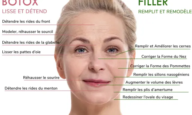 Une femme montre les zones du visage traitées par Botox et Filler. Le sillon nasogénien est une zone ciblée par le Filler pour un effet rajeunissant.