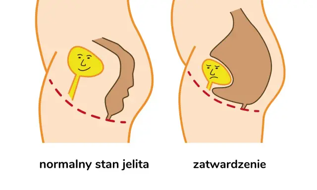 Normalne jelito z uśmiechniętą kupką vs. zatwardzenie z płaczącą kupką, co powoduje ból przy robieniu kupy.