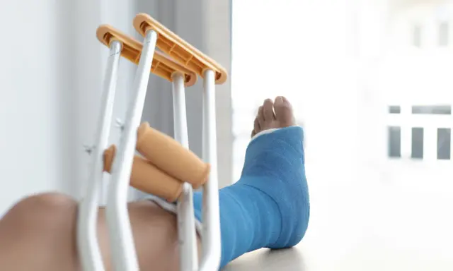 Noga w niebieskim gipsie, obok kul ortopedycznych. Diagnoza: złamanie kostki bocznej z przemieszczeniem.