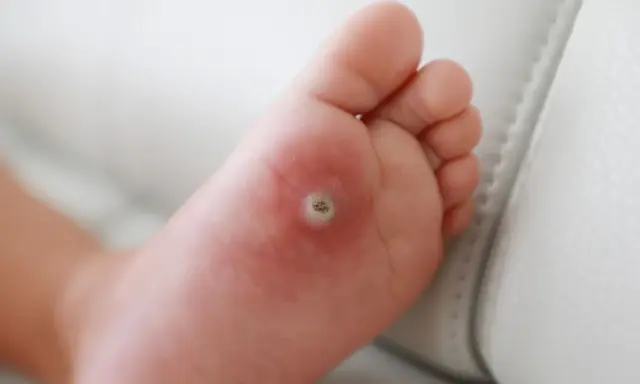 Dziecko ma kurzajkę na stopie, która jest widoczna na podeszwie.