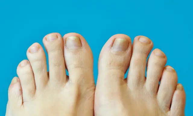 Gros plan sur des pieds montrant des ongles jaunis et épaissis, symptômes possibles de psoriasis ongle pied.