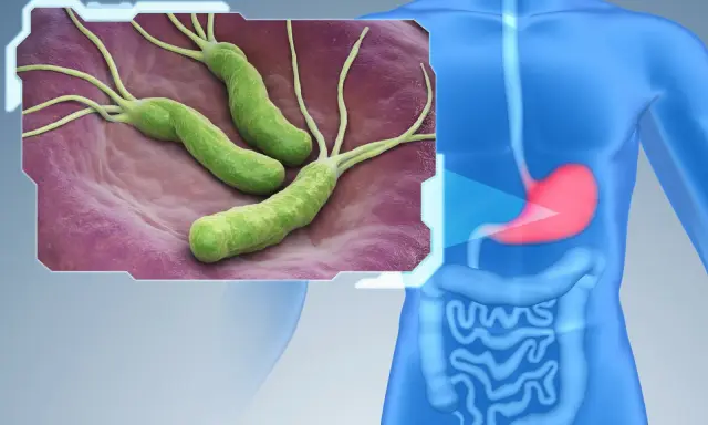 Bakterie Helicobacter pylori w żołądku. Dowiedz się, jak wyleczyć helicobacter.