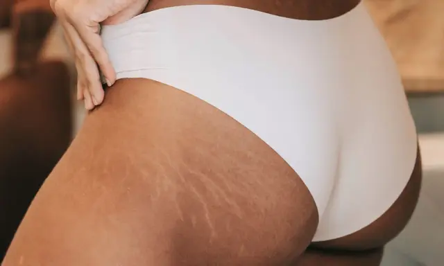 Pelle con inizio smagliature gravidanza, un segno naturale del corpo che cambia.
