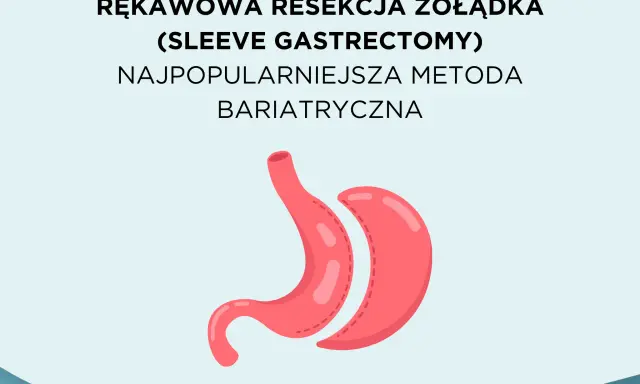 Rękawowa resekcja żołądka, najpopularniejsza metoda bariatryczna, przedstawiona jako stylizowany obraz żołądka.