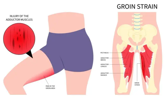 Illustration zeigt Adduktoren-Schmerzen im Leistenbereich, mit hervorgehobenen Muskeln und einer roten Zone, die eine Zerrung signalisiert.