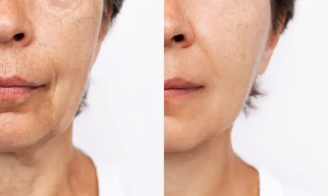 Comparaison avant/après : peau marquée par les rides du sommeil d'un côté, peau plus lisse et rajeunie de l'autre.