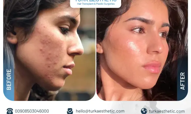 Prima e dopo un trattamento co2 laser viso per acne e imperfezioni. Pelle visibilmente più liscia e luminosa.