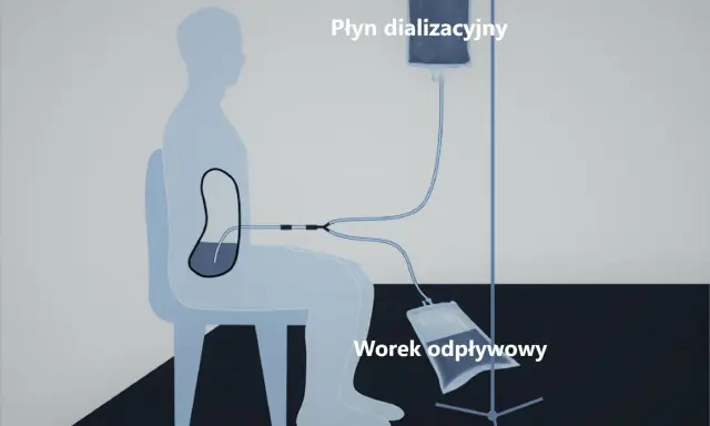 Schemat dializy otrzewnowej: cewnik Tenckhoffa w jamie otrzewnej pacjenta, podłączony do worka z płynem dializacyjnym i worka odpływowego.