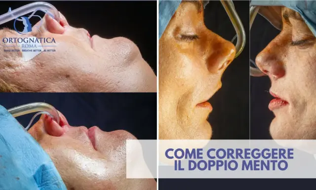 Prima e dopo un intervento per correggere il doppio mento. Immagini ravvicinate del viso di una persona durante una procedura medica.