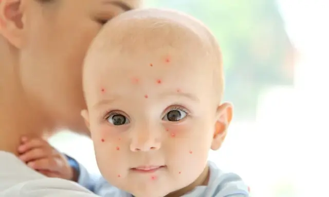 Un bébé est tenu par sa mère, son visage est couvert de petites taches rouges de varicelle.