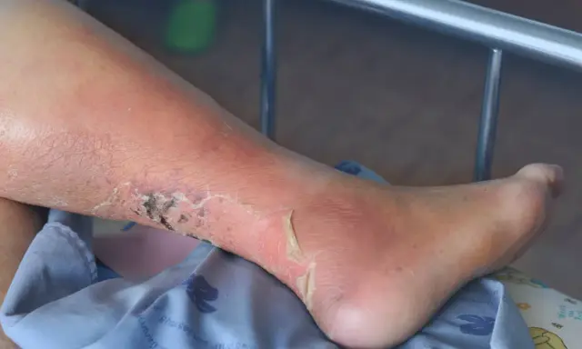 Gamba con edema e ulcere alle caviglie, la pelle è arrossata e screpolata, con aree di necrosi.
