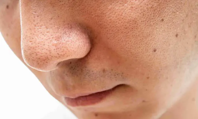 Gros plan sur un nez et une bouche, montrant des pores dilatés et quelques points noirs sur le visage.