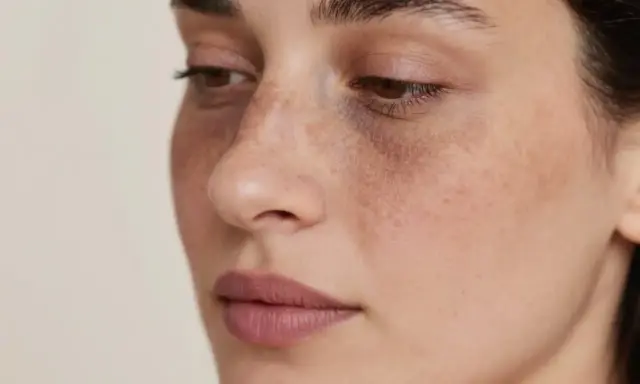 Visage d'une femme avec des taches brunes sous les yeux, évoquant le masque de grossesse du 1er trimestre.