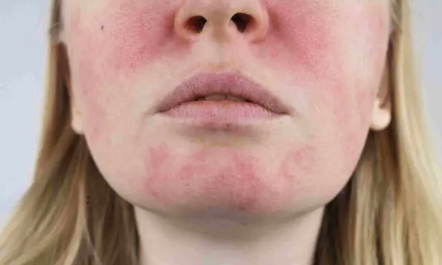 Une tache rouge sur le visage, près des lèvres et des joues, suggère une irritation cutanée.