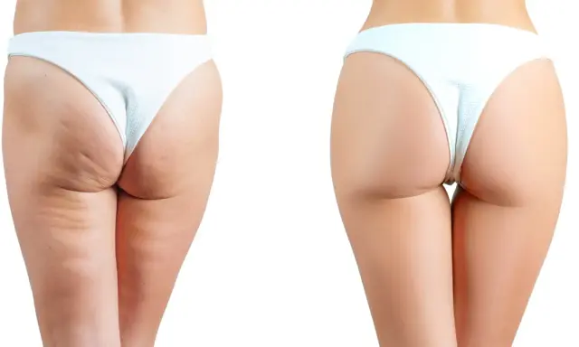 Comparaison avant/après : réduction visible de la cellulite sur les fesses, peau plus lisse et ferme.