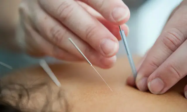 Dłonie terapeuty wprowadzają igły do akupunktury. Często zadajemy sobie pytanie, jak często stosować suche igłowanie dla najlepszych efektów.
