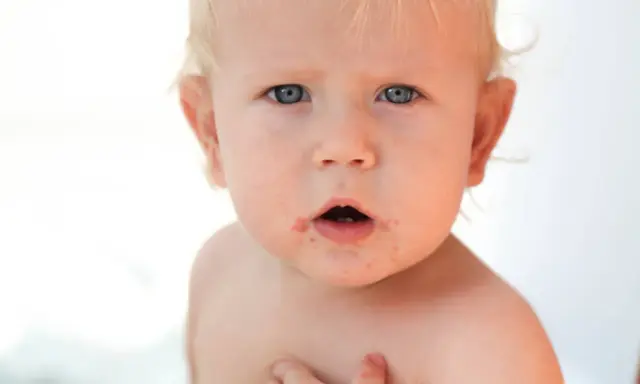 Visage d'un bébé aux yeux bleus, présentant des rougeurs autour de la bouche, possiblement un eczéma bouche bébé.