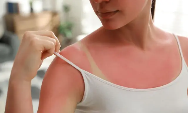 Épaule rouge vif, marquée par une cicatrice soleil due à un coup de soleil. La peau est irritée, témoignant d'une exposition excessive au soleil.