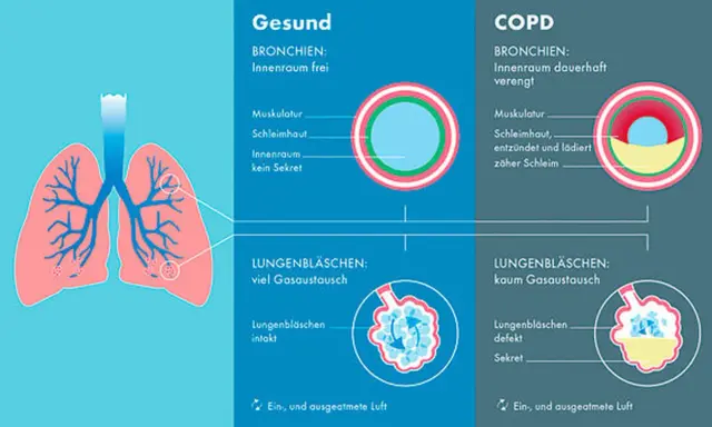 Vergleich gesunder Lungen mit COPD: Verengte Bronchien und defekte Lungenbläschen bei COPD erschweren den Gasaustausch.