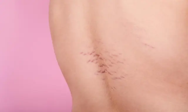 Pelle con smagliature viola, segni di crescita o cambiamenti corporei, su sfondo rosa.