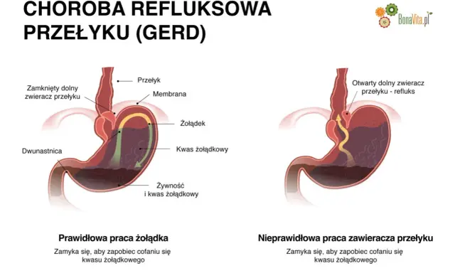 Objawy refluksu u dorosłych: Nie tylko zgaga! Kiedy iść do lekarza?